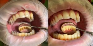 Результат профессиональной гигиены полости рта