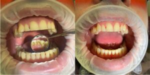 Зубы после профессиональной чистки 